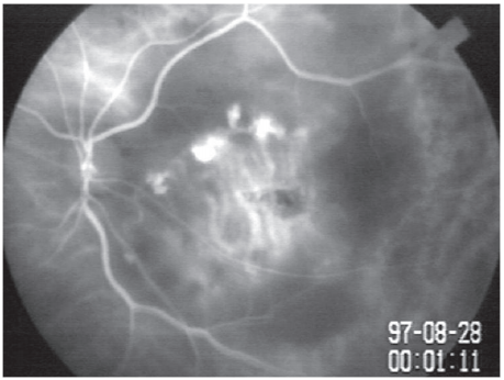 图 2 笔者在国内报道的第一例息肉状脉络膜血管病变 Figure 2 The first reported case of polypoidal choroidal vasculopathy in China