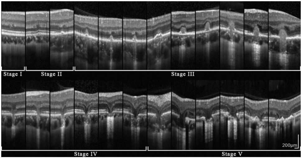 图 3 PIC病灶的5个分期 Figure 3 Five stages of PIC lesion