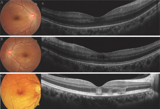 图2 登革相关黄斑病变OCT分型 Figure 2 OCT classification of Dengue-related macular degeneration