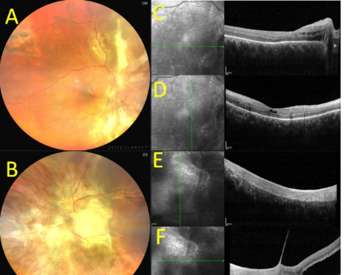 图4 病例2抗弓形虫治疗10d后的眼底和OCT图 Figure 4. Case 2 Fundus and OCT imaging 10 days post anti-toxoplasma therapy.