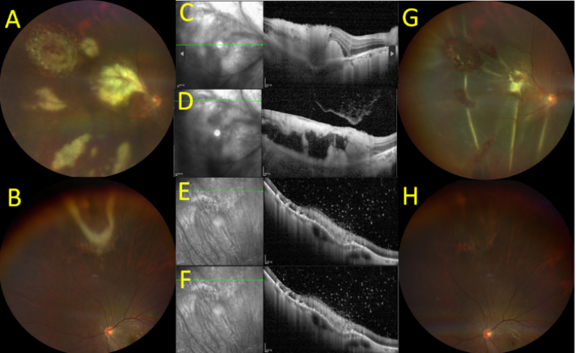 图5 病例3的双眼眼底图和治疗效果 Figure 5. Case 3: bilateral fundus findings before and after anti-toxoplasma therapy