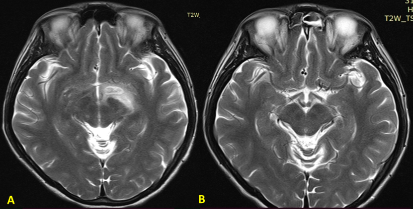 图6 病例３初次就诊时的脑部MRI和治疗2个月后的脑MRI Figure 6. Case 3: Brain MRI at Initial Presentation and After 2 Months of Treatment