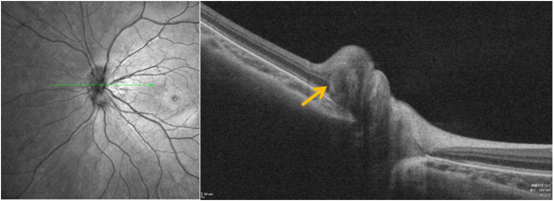 图 6 TDS合并PHOMS患者OCT成像，PHOMS(黄色箭头) Figure 6 OCT imaging of patients with TDS combined with PHOMS, PHOMS (yellow arrow)