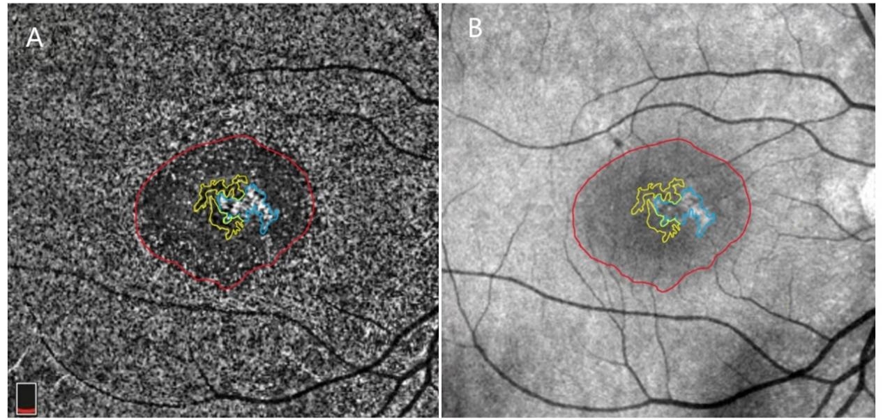 图 4 OCTA中的3类主要异常 Figure 4 Tree main types of abnormalities in OCTA