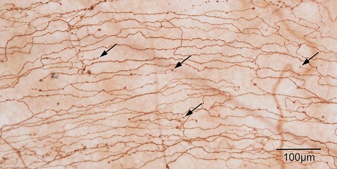 Fig 4. Subbasal nerves in the peripheral cornea. Arrows, bulbous nerve endings in the basal epithelial cell layer48