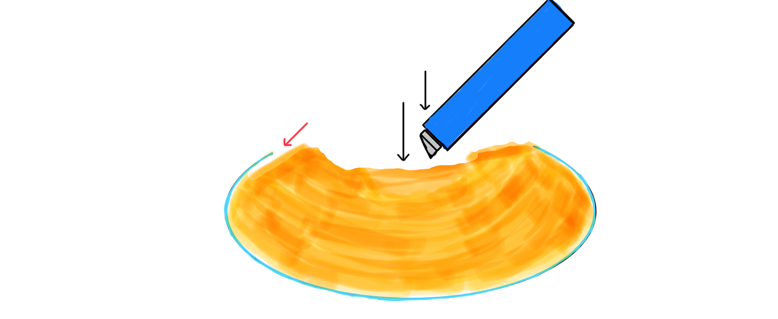 图2 超声乳化针头轻压核块中心点 Figure 2 The phacoemulsification needle gently presses on the central point of the nuclear