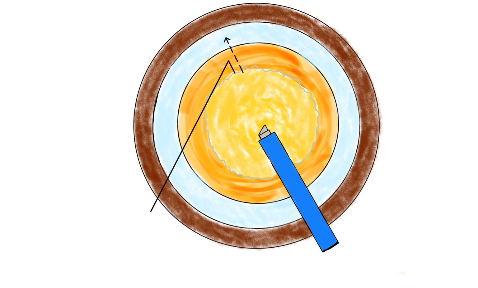 图3 劈核钩自5点钟位前囊口下滑入晶状体赤道部并勾住维持Figure 3 The nucleus-splitting hook is slid into the equatorial region of the lens from the 5 o'clock position of the anterior capsule opening and is then hooked and held in place