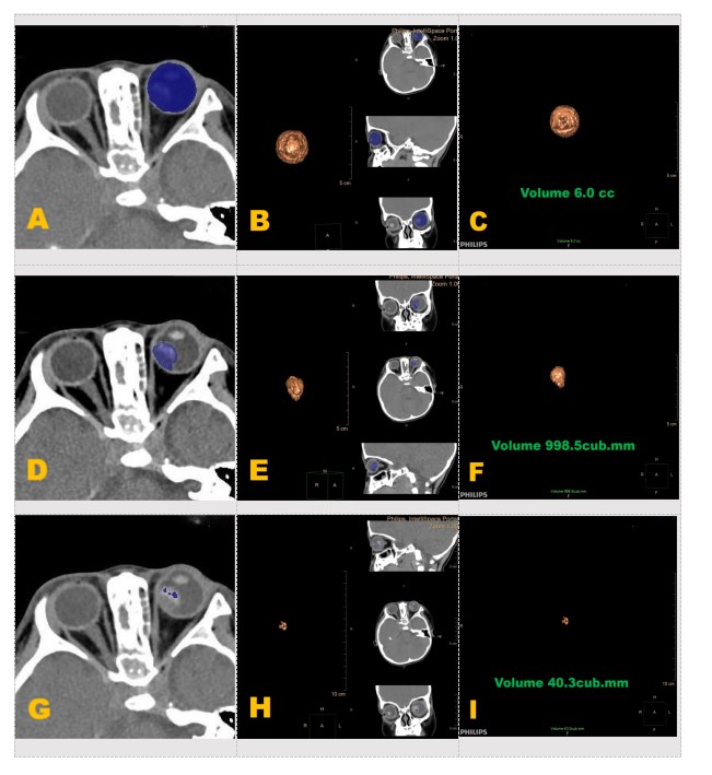 图2容积测量步骤示图 Figure 2 Diagram of volume - measurement steps