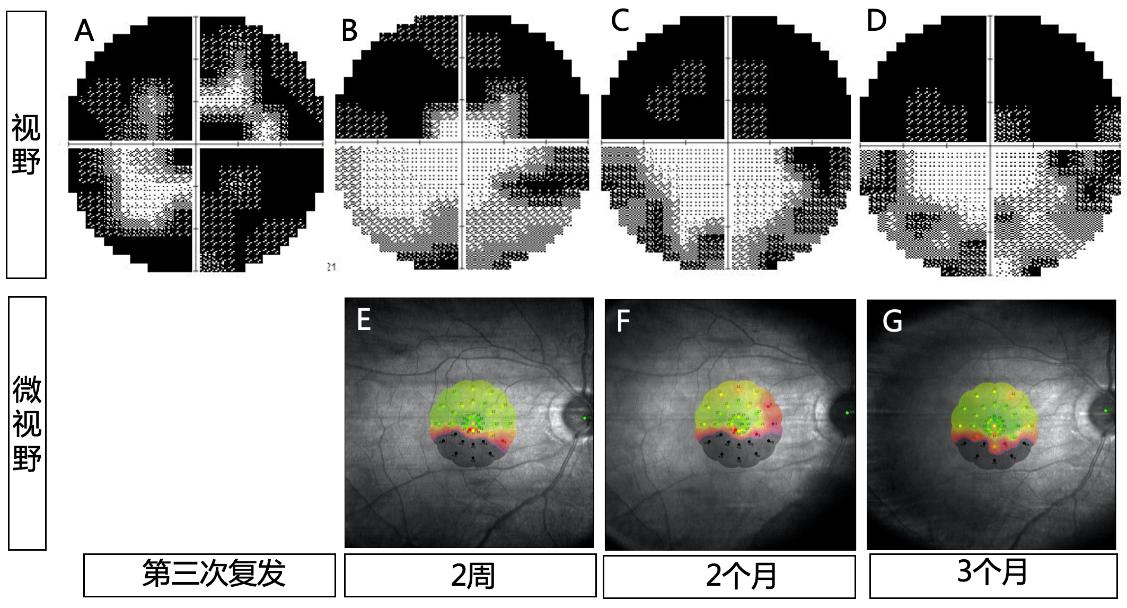 图2 本例患者第三次复发病程中视野及微视野的变化 （A）发病时患者的视野（MD值：-25.43 dB）；（B）和（E）经过急性期激素冲击和血浆置换治疗后，视野（MD值：-19.37 dB）有改善，黄斑微视野（平均阈值：19.2 dB）；（C）和（F）发病后2个月激素减量过快视野（MD值：-21.80 dB）和微视野（平均阈值：16.6 dB）损伤加重；（D）和（G）调整口服甲泼尼龙片用量至80 mg，缓慢序贯减量，发病后3个月患者视野（MD值：-21.61 dB）及微视野（平均阈值：20.7 dB）均稍有改善。 Figure 2 Changes in visual field and macular microperimetry during the third relapse in the patient (A) Visual field at the onset of relapse (MD value: -25.43 dB); (B) and (E) After acute-phase treatment with high-dose steroid pulse therapy and plasmapheresis, the visual field (MD value: -19.37 dB) showed improvement, and macular microperimetry (average threshold: 19.2 dB) was recorded; (C) and (F) Two months after the onset (during steroid tapering), the visual field (MD value: -21.80 dB) and microperimetry (mean threshold: 16.6 dB) worsened. (D) and (G) After adjusting the oral prednisone dose to 80 mg and implementing a slow, sequential tapering regimen, the patient's visual field (MD value: -21.61 dB) and microperimetry (mean threshold: 20.7 dB) showed slight improvement at 3 months post-onset.