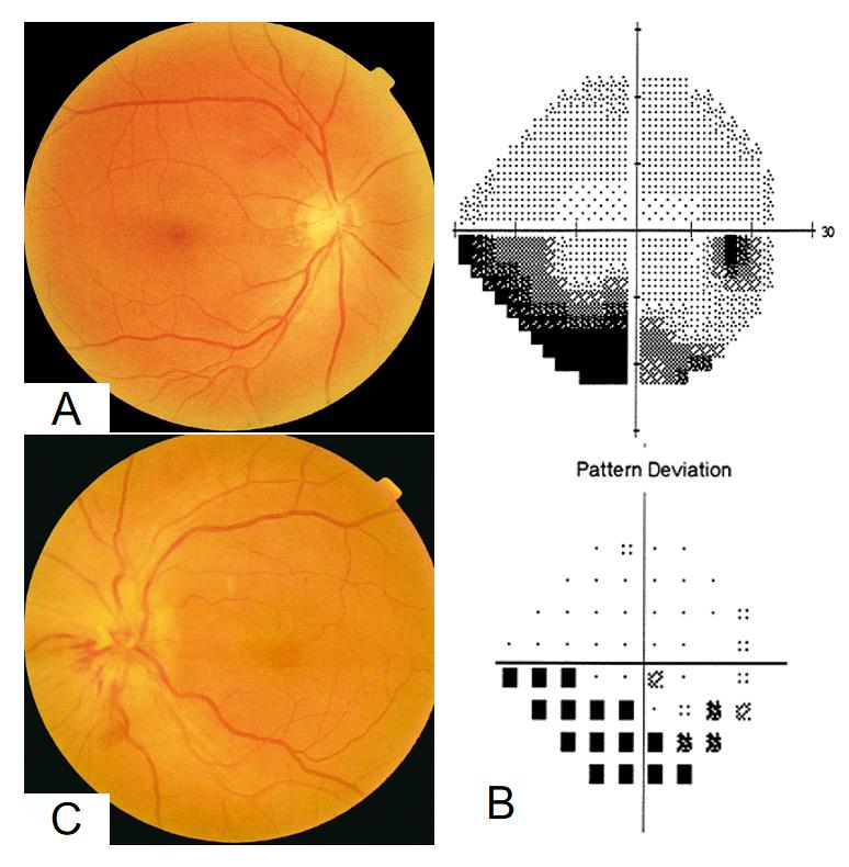 图1:首次就诊的眼底照相和视野、三个月后的眼底照相 Figure 1 Fundus photograph and visual field at the initial visit, and fundus three months later