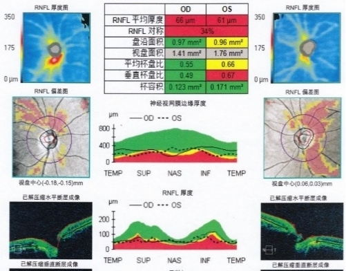 图2:患者首次就诊的眼底照相、OCT和视野 Figure 2: Fundus photograph, OCT, and visual field of the initial visit.