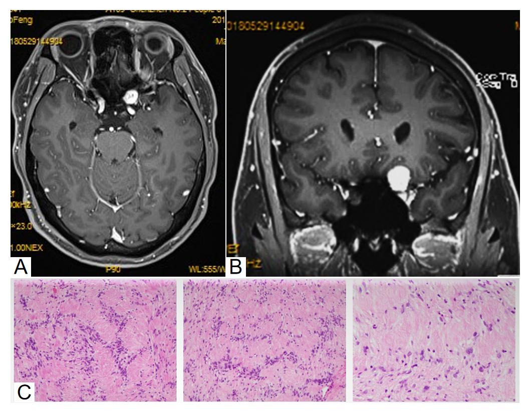 图4:颅脑和眼眶MRI增强序列和病理 Figure 4: Cranial and orbital MRI contrast-enhanced sequences and pathology