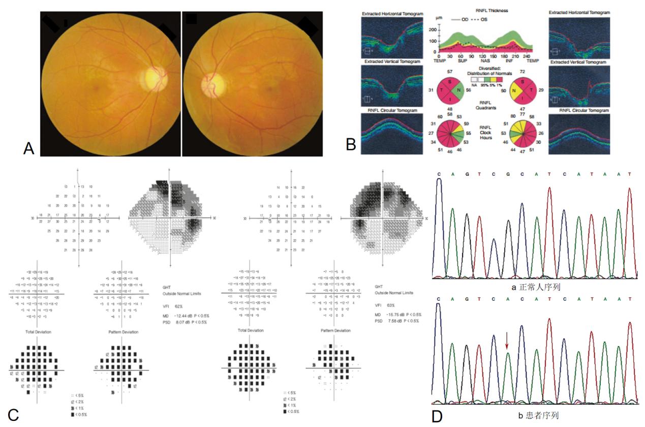 图5：患者眼底照相、OCT、视野和基因检测报告 Figure 5:&nbsp;Fundus photography, OCT, visual field, and genetic test results of the patient