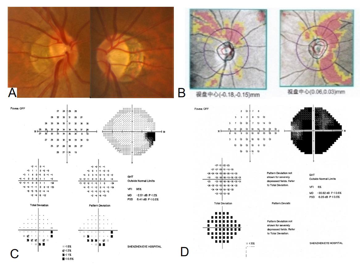 图2:患者首次就诊的眼底照相、OCT和视野 Figure 2: Fundus photograph, OCT, and visual field of the initial visit.