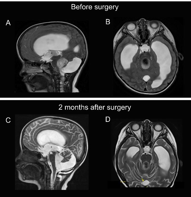 图1 Dandy-Walker综合征患儿术前及第一次术后MRI影像 Figure 1 Preoperative and postoperative MRI images of the patient with Dandy-Walker syndrome.