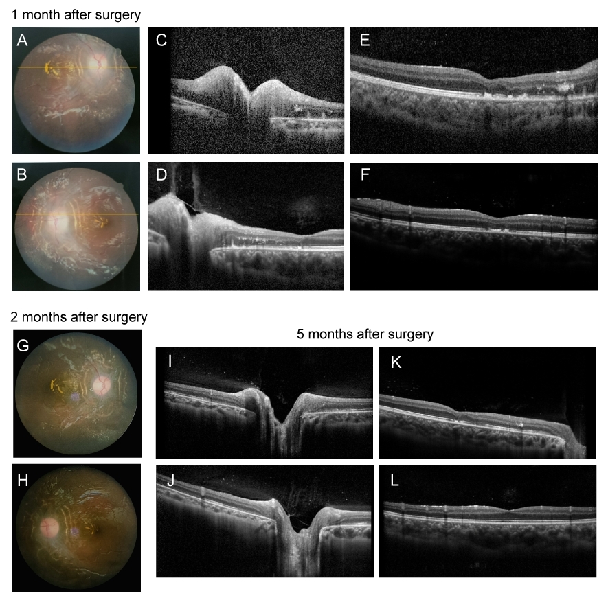 图2 Dandy-Walker综合征患儿第一次手术1、2、5个月后眼部随访情况 Figure 2 Ocular manifestations follow-up of the patient with Dandy-Walker syndrome 1 month, 2 months, and 5 months after the first surgery.