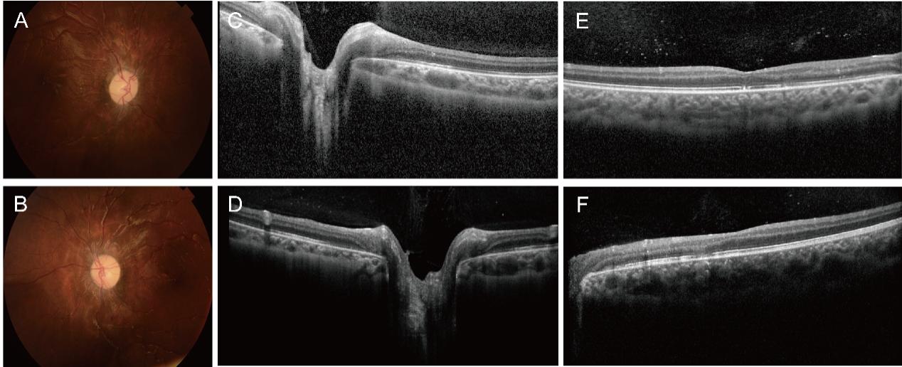 图4 Dandy-Walker综合征患儿右侧脑室腹腔分流术后1月余眼部随访情况 Figure 4 Ocular follow-up more than 1 month after right ventriculoperitoneal shunt in the patient with Dandy-Walker syndrome.