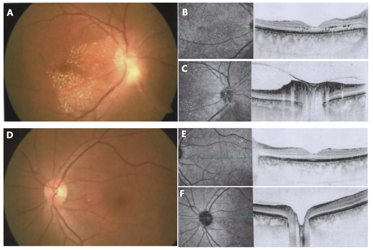 图2 患者起病1周时当地初诊时右眼眼底照相及OCT改变