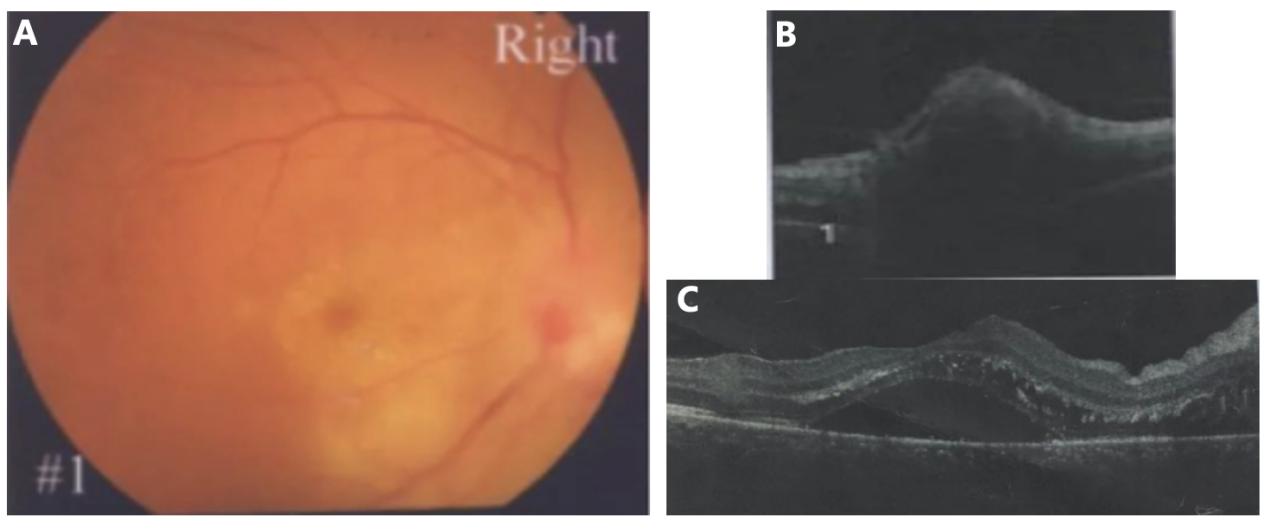 图1 患者首次至我院就诊时（起病3周）眼底表现及OCT改变