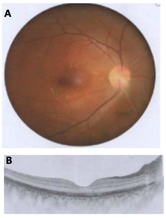 图3 右眼治疗3月后眼底表现及OCT改变