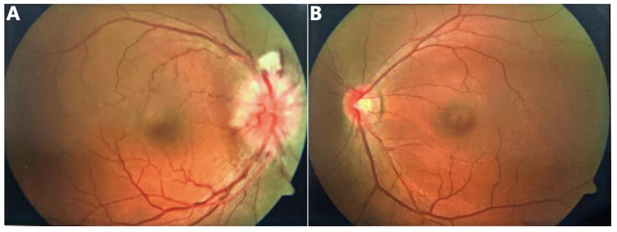 图4 双眼起病时眼底表现