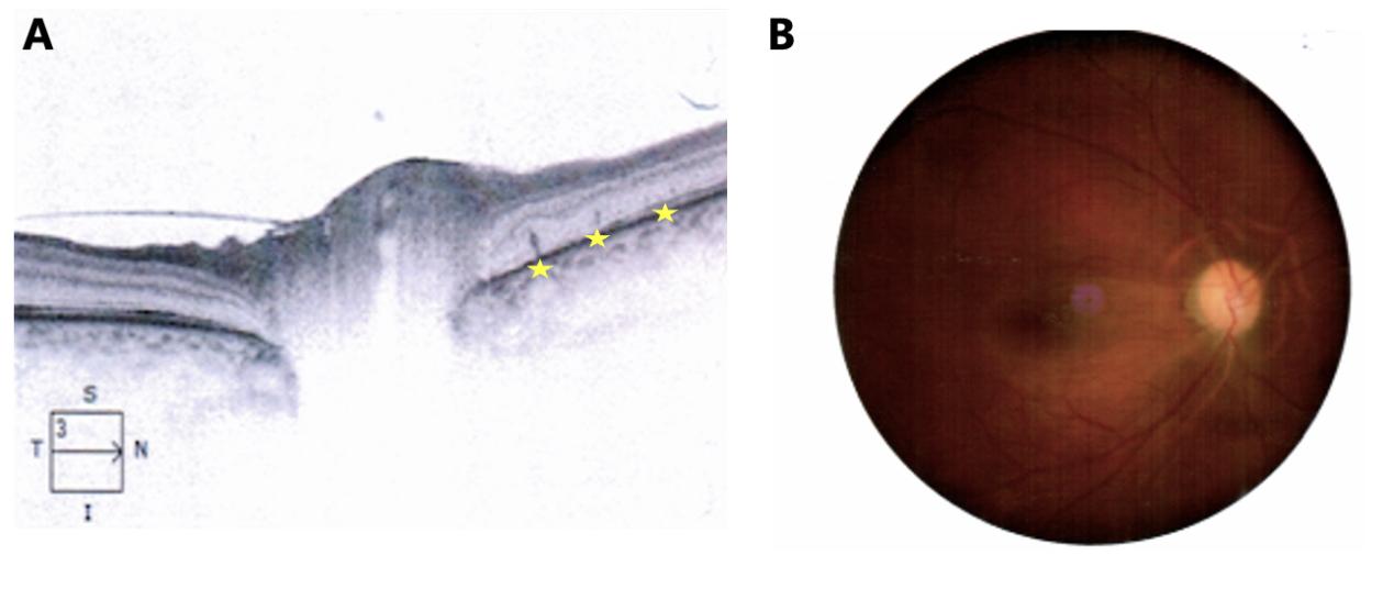 图6 治疗后右眼OCT及眼底表现