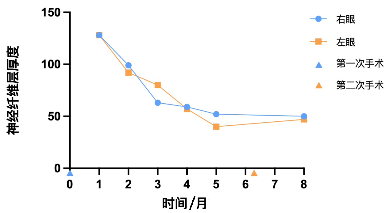 图3 Dandy-Walker综合征患儿视网膜神经纤维层厚度随时间变化 Figure 3 RNFL thickness over time in the patient with Dandy-Walker syndrome.