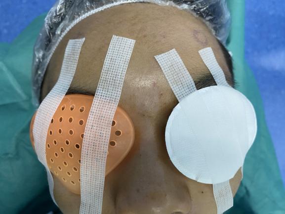 图2 一眼眼垫+一眼眼罩Figure 2 an eye pad and an eye shield
