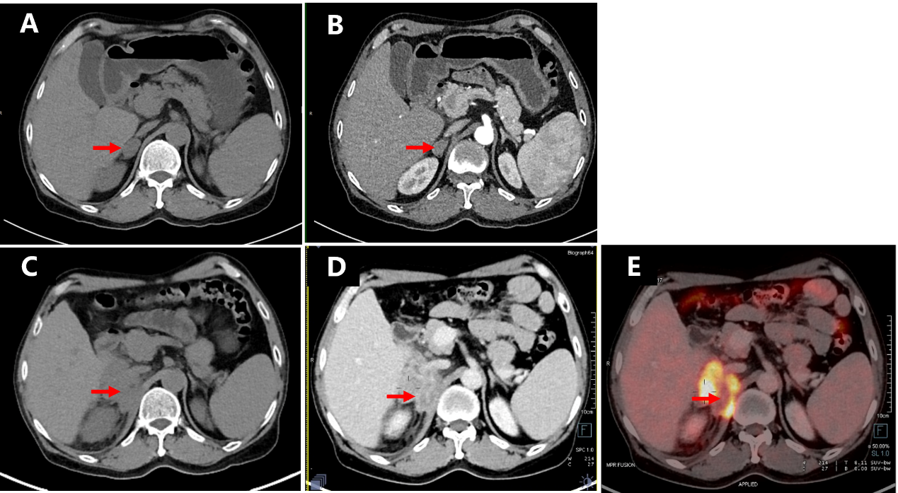 Figure 3. Initial and follow-up diagnostic CT images and follow-up PET-CT image of the right adrenal gland of this patient