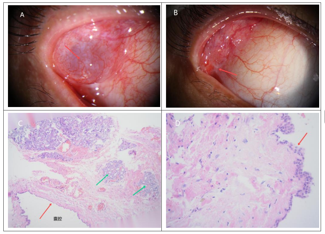 图1 病例13右眼睑叶泪腺导管囊肿患者的临床及病理检查 Figure 1 Clinical and pathological examination of a lacrimal duct cyst in the palpebral lobe of the right eye of Case 13